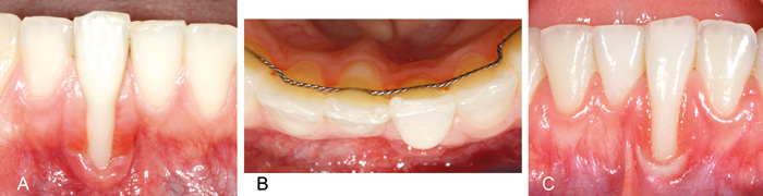 illustrasjon: Gingivale retraksjonar - er kjeveortopedisk behandling ein risikofaktor?