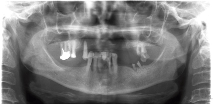 illustrasjon: Avtakbare underkjeveproteser: Er en protese støttet på to implantater alltid det beste behandlingsalternativet?