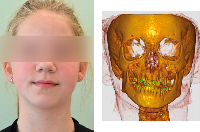 illustrasjon: Juvenil idiopatisk artritt - hva en tannlege bør vite