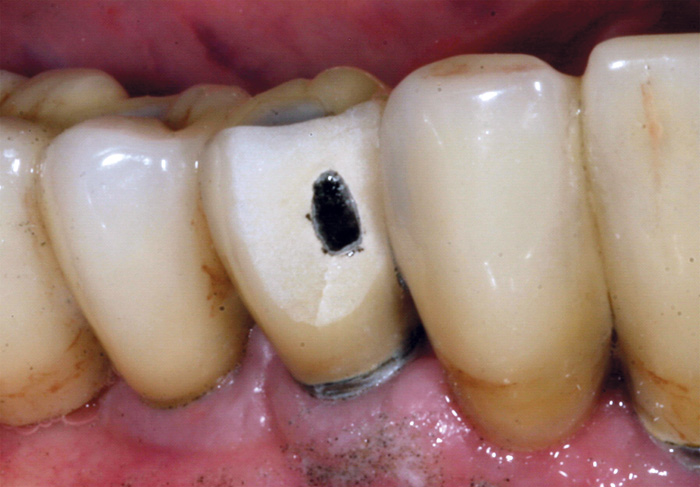 illustrasjon: Intraoral reparasjon av dekk-keram