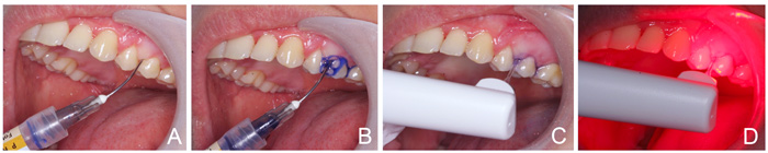 illustrasjon: Tilleggseffekten av fotodynamisk terapi ved ikke-kirurgisk periodontal behandling