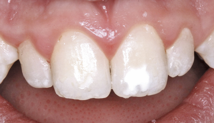 illustrasjon: Emaljeutviklingsforstyrrelser på permanente incisiver etter periodontalskade i det primære tannsett - en oppfølgingsstudie