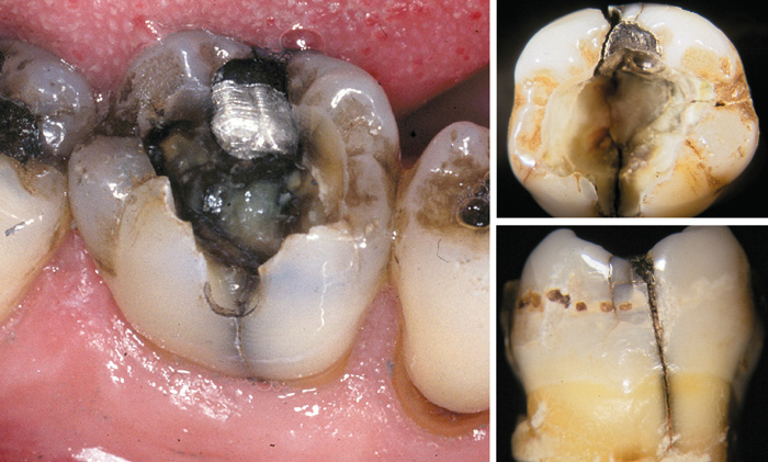 illustrasjon: Acute dental pain II: pulpal and periapical pain