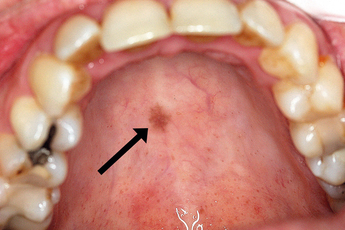 illustrasjon: Oral melanotisk flekk - en kasuistikk
