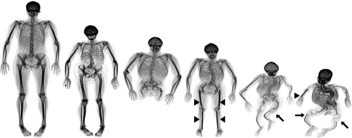 illustrasjon: Osteogenesis imperfecta - odontologiske implikationer