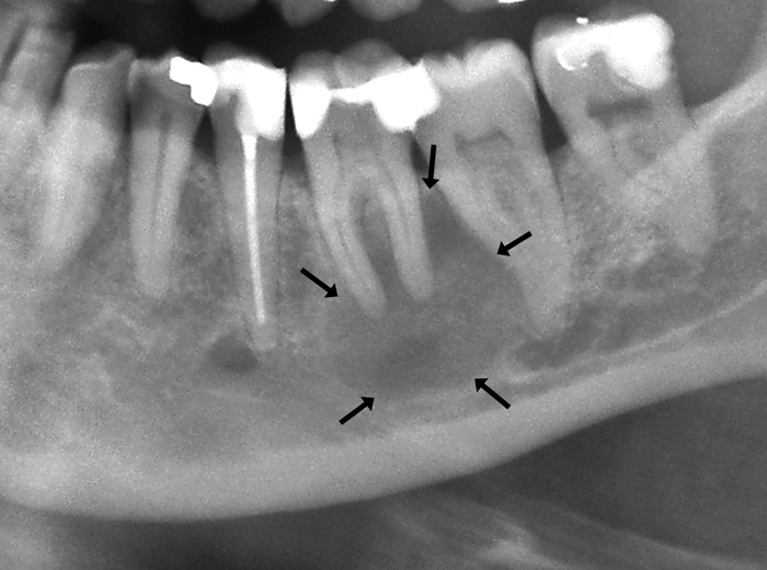 illustrasjon: Et tilfelle av sentralt ossifiserende fibrom