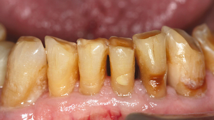 illustrasjon: Dental diseases and their treatment in the older population