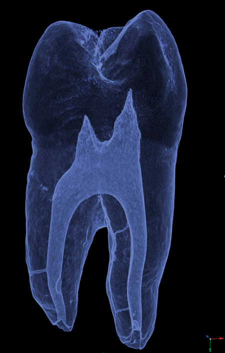 illustrasjon: Endodontiske materialer - skyllemidler, sealere og obturerende materialer