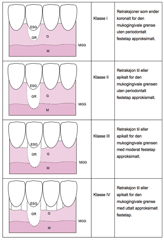 illustrasjon: Gingivale retraksjoner