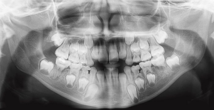 illustrasjon: Molar-incisiv misdannelse - beskrivelse og diagnostisk protokoll