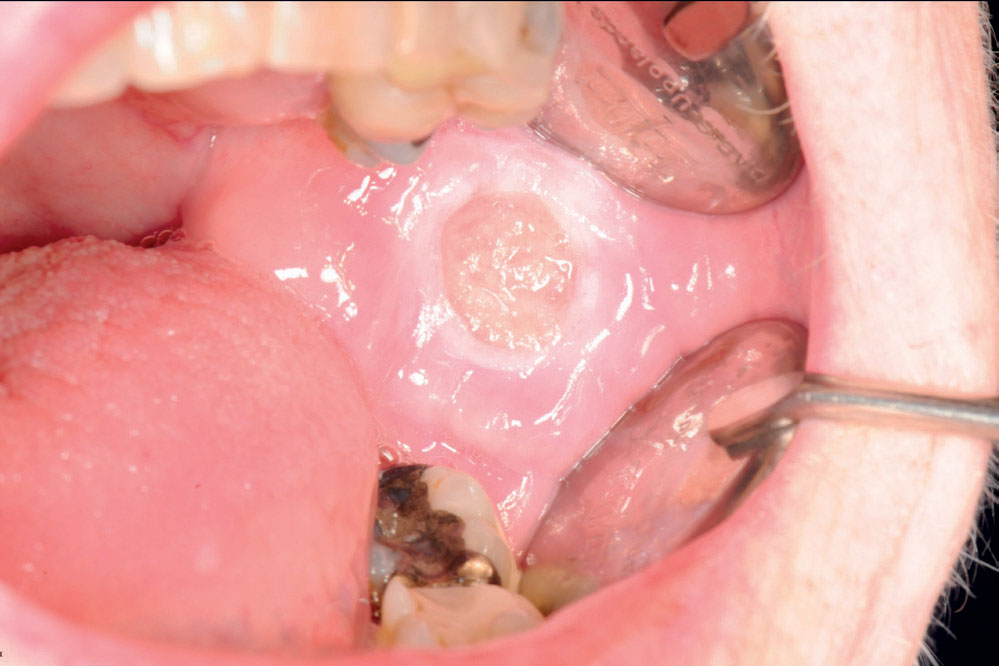 illustrasjon: Sår i munnhulen som ikke vil tilhele kan være traumatisk ulcerativt granulom med stromal eosinofili (TUGSE)