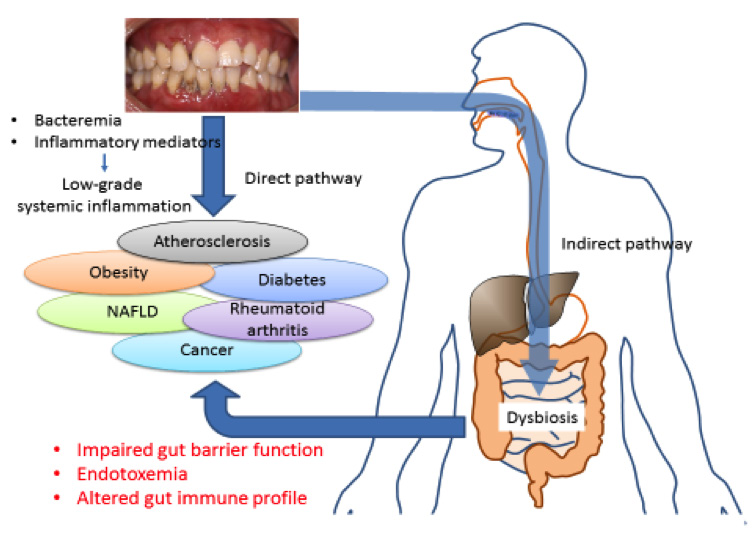 illustrasjon: Kan orale bakterier påvirke mikrofloraen i tarm?