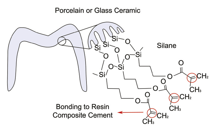 illustrasjon: Bonding ceramic restorations