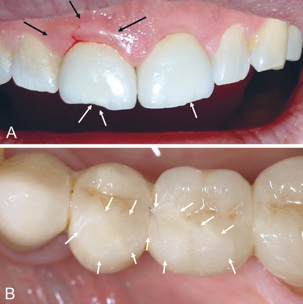 illustrasjon: Clinical outcomes of ceramic restorations