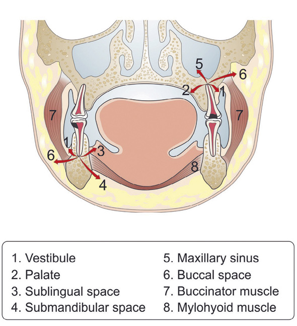 illustrasjon: Treatment of acute dental infections