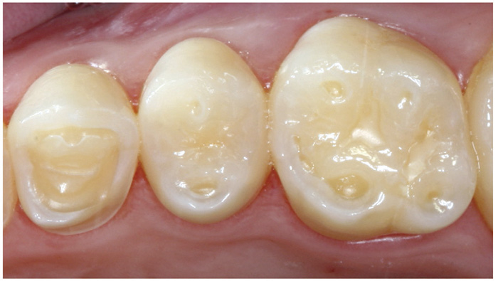 illustrasjon: Dentale erosjoner - forekomst, registrering, årsaker, genetikk og prinsipper for behandling