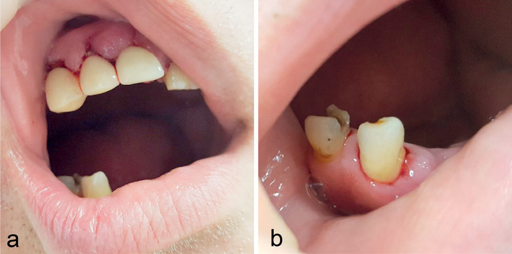 illustrasjon: Myasthenia gravis og orale utfordringer