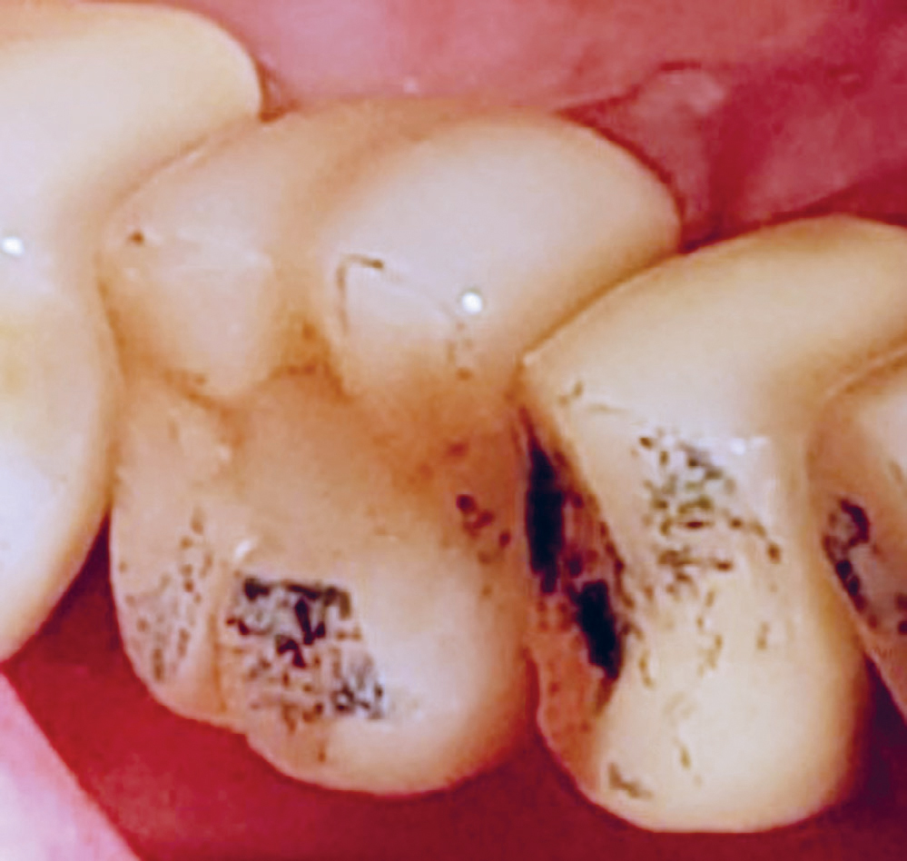 illustrasjon: Re-osseointegrasjon av et mobilt implantat – En kasuistikk