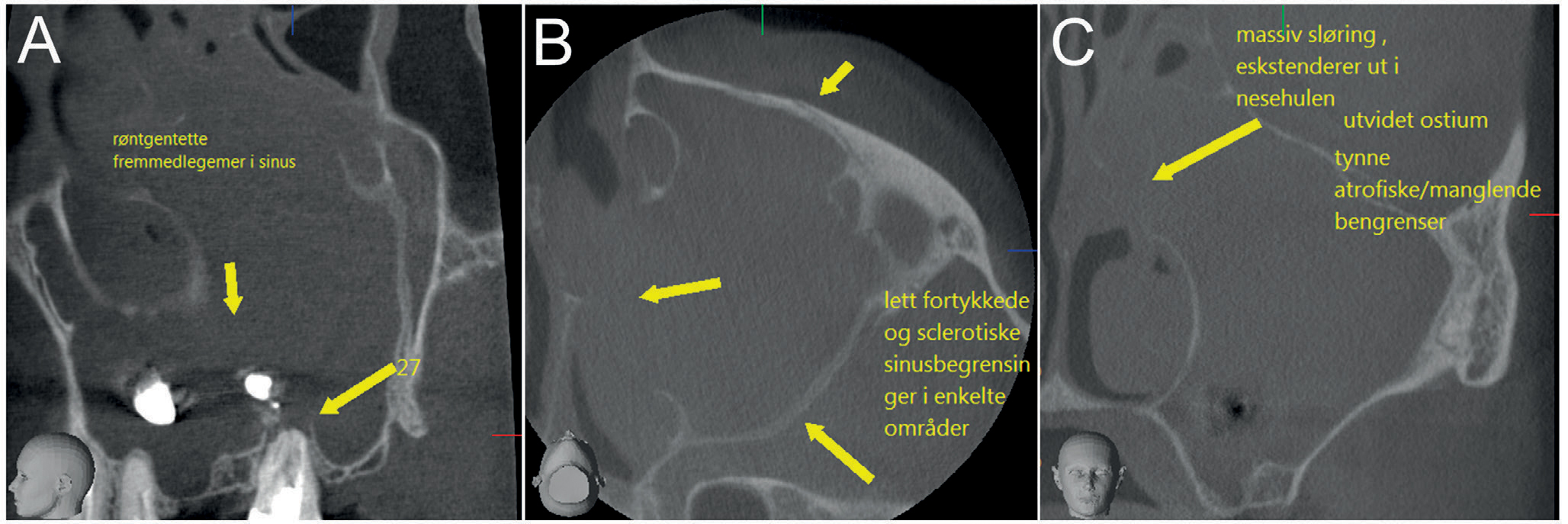 illustrasjon: Fremmedlegemer i sinus maxillaris