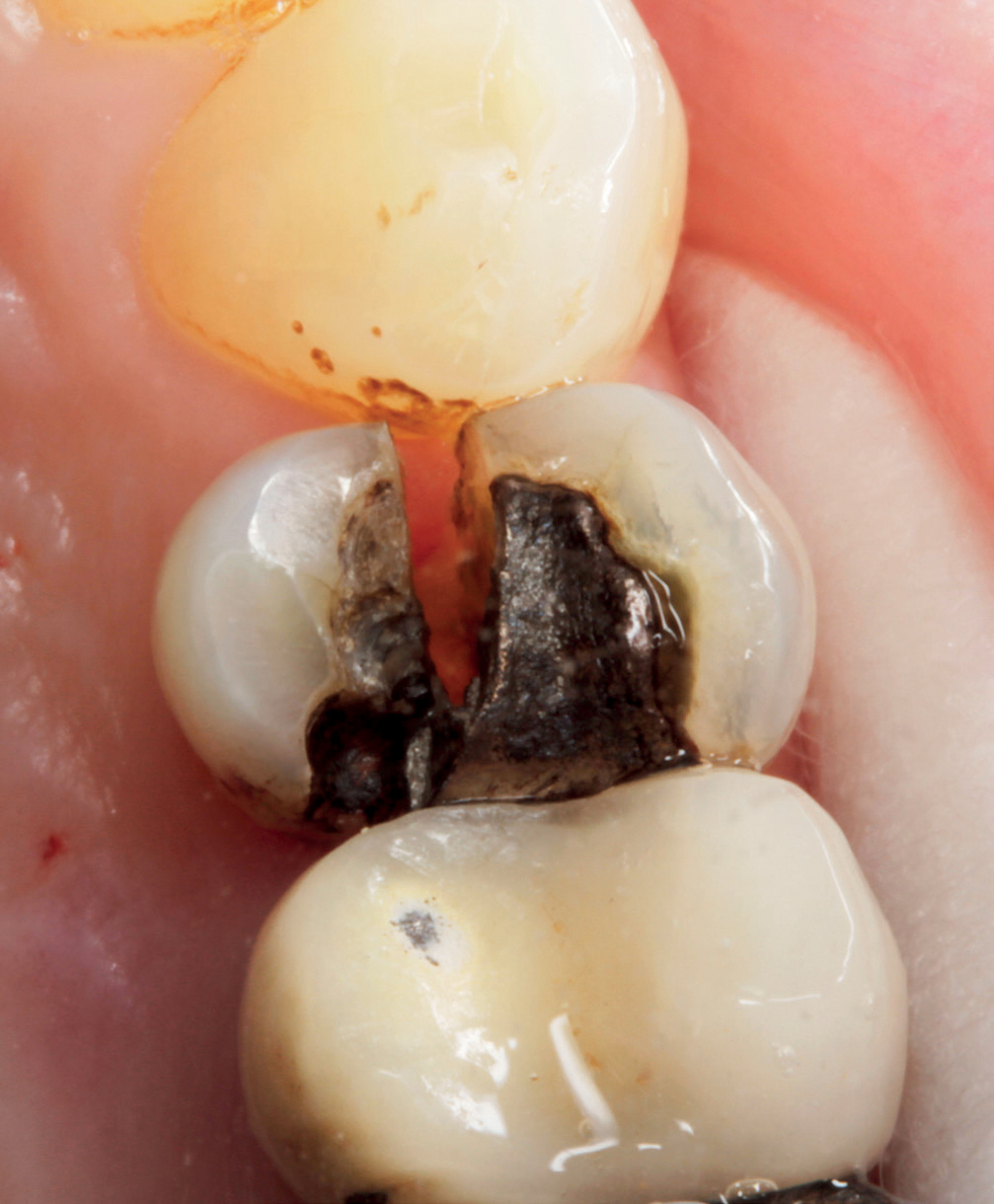 illustrasjon: Ufullstendige tannfrakturer: Klassifikasjon, etiologi og behandling