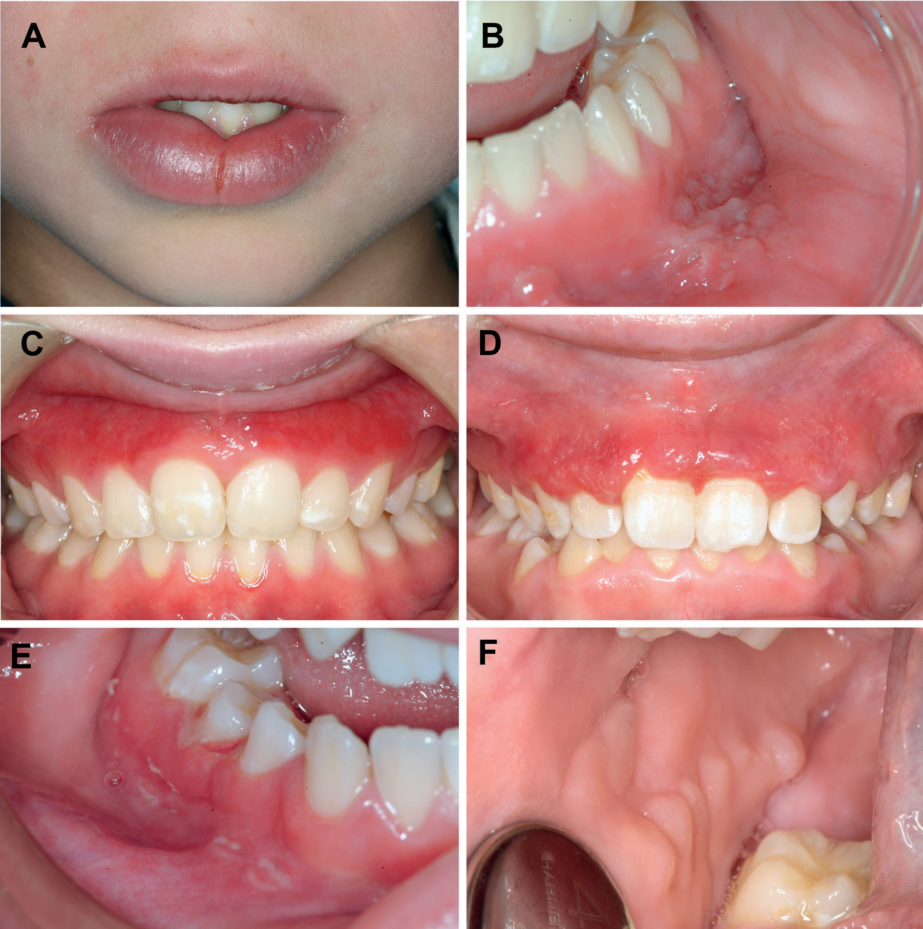 illustrasjon: Orofacial granulomatose og Crohns sykdom – et klinisk kasus og en litteraturgjennomgang