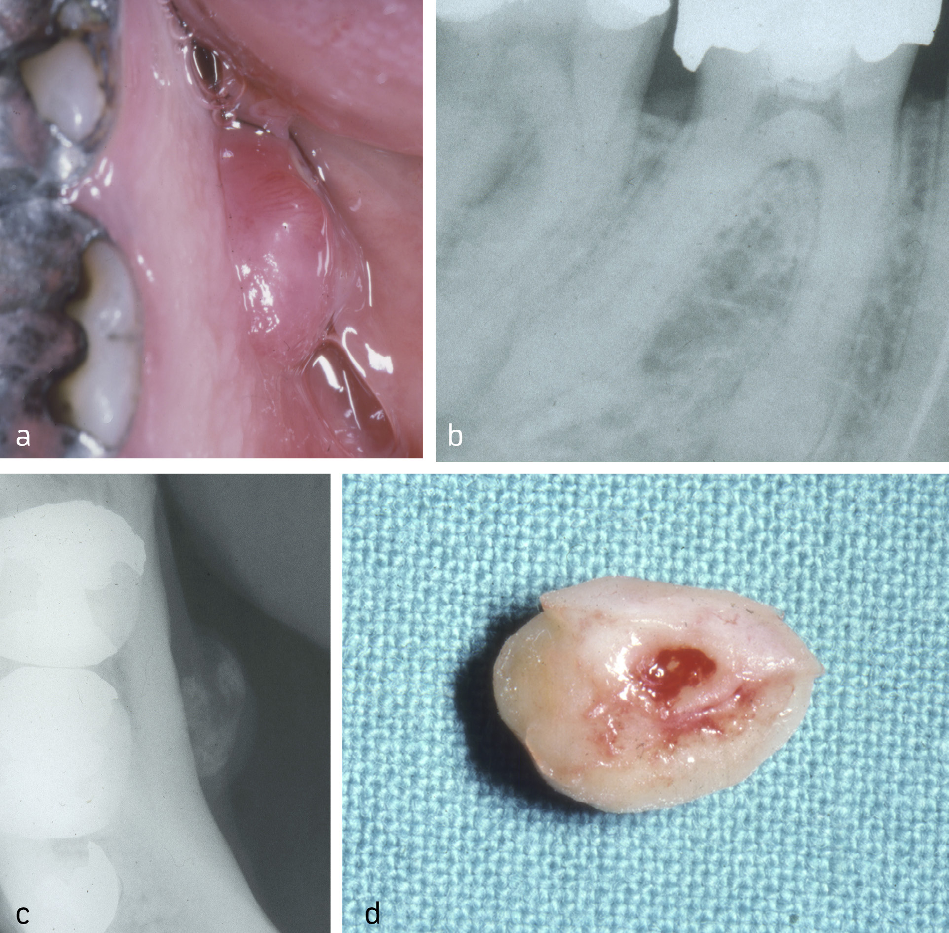 illustrasjon: Perifert ossifiserende fibrom – en vanskelig klinisk diagnose