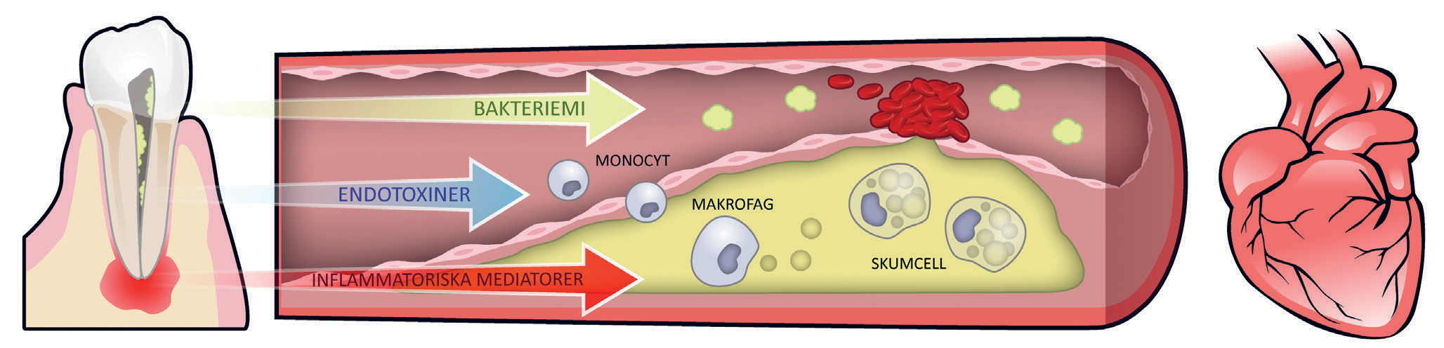 illustrasjon: Endodontiska infektioner och allmänhälsa