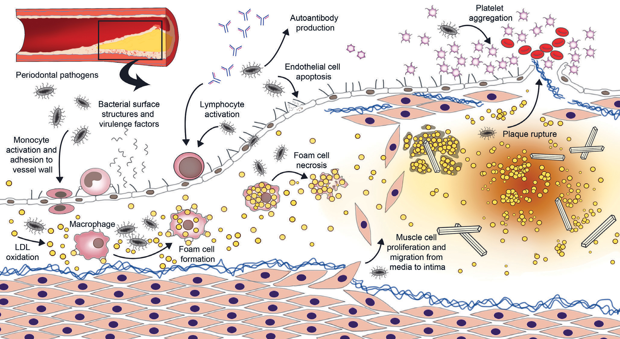 illustrasjon: Association between oral infections and cardiovascular diseases