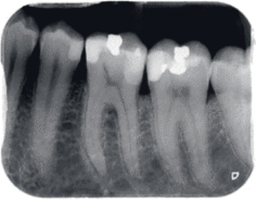 illustrasjon: Anafylaksi etter endodontisk behandling