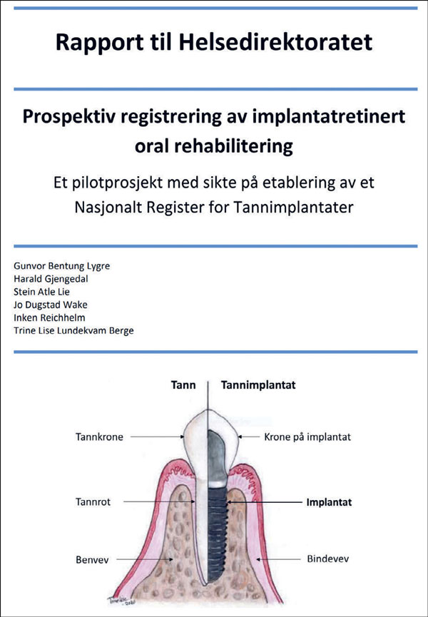 illustrasjon: Pilotprosjekt med sikte på etablering av et nasjonalt register for tannimplantater