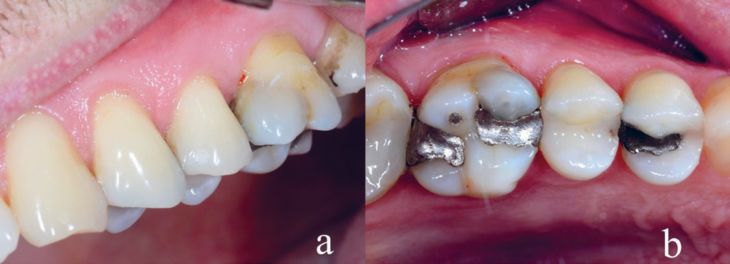 illustrasjon: Ufullstendige tannfrakturer: To kasus