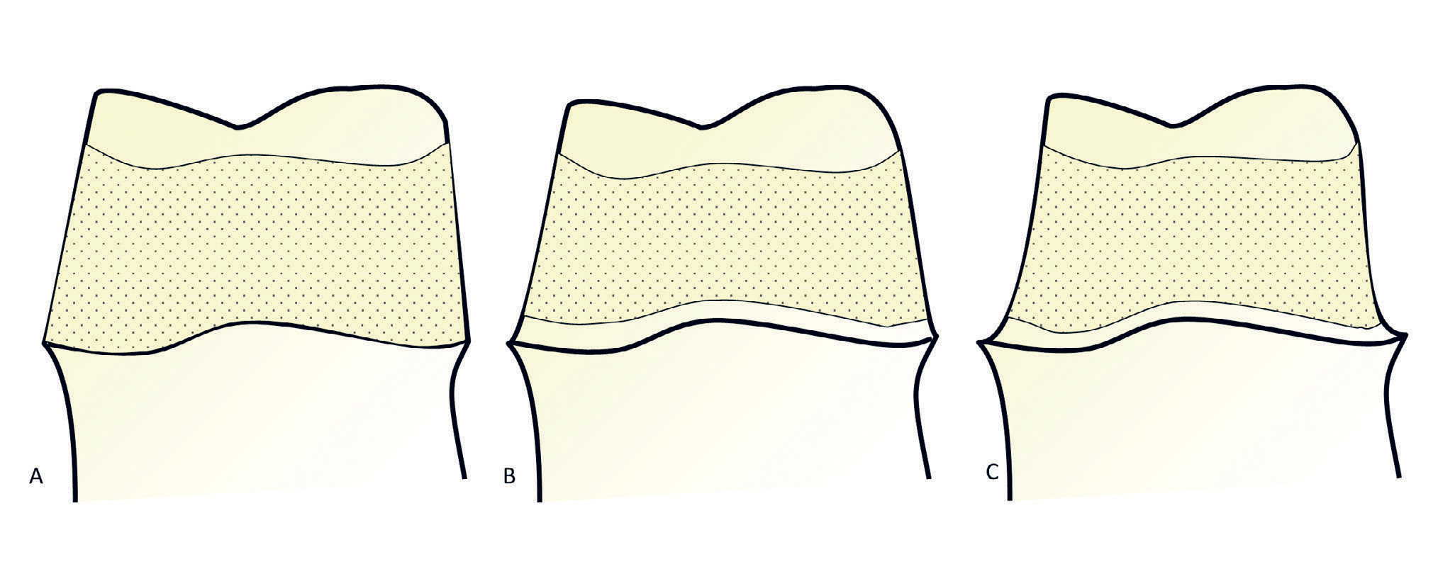 illustrasjon: Retensjon av sementerte protetiske erstatninger