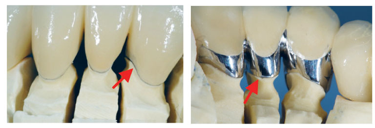 illustrasjon: Sementeringsprosedyrer for permanente indirekte restaureringer