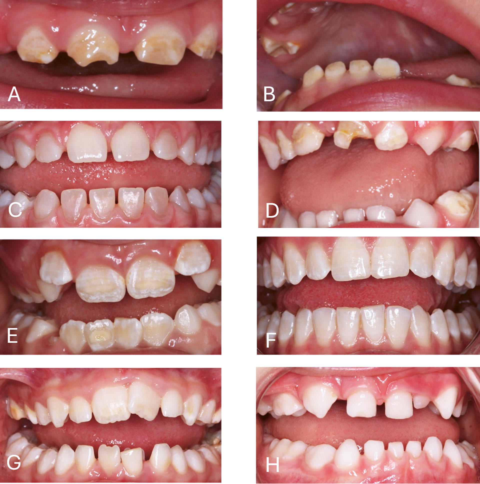 illustrasjon: 2025/09/Genetiske-syndromer-som-medf-rer-utviklingsforstyrrelser-i-emalje-og-dentin