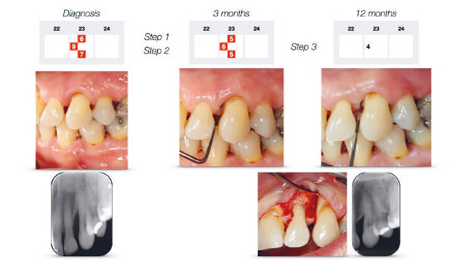 illustrasjon: Anbefalinger fra European Federation of Periodontology og retningslinjer i de nordiske lande