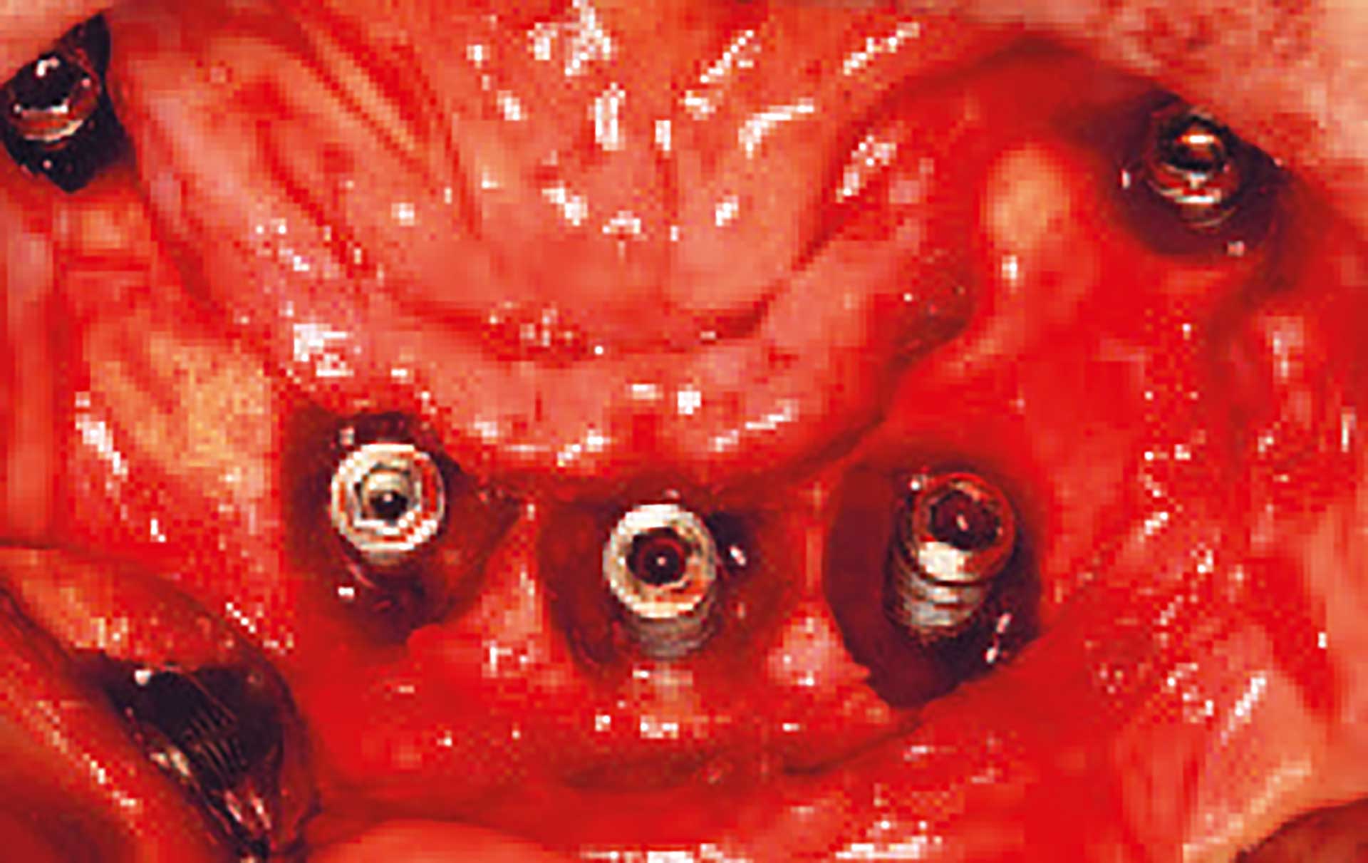 illustrasjon: Behandling af periimplantitis