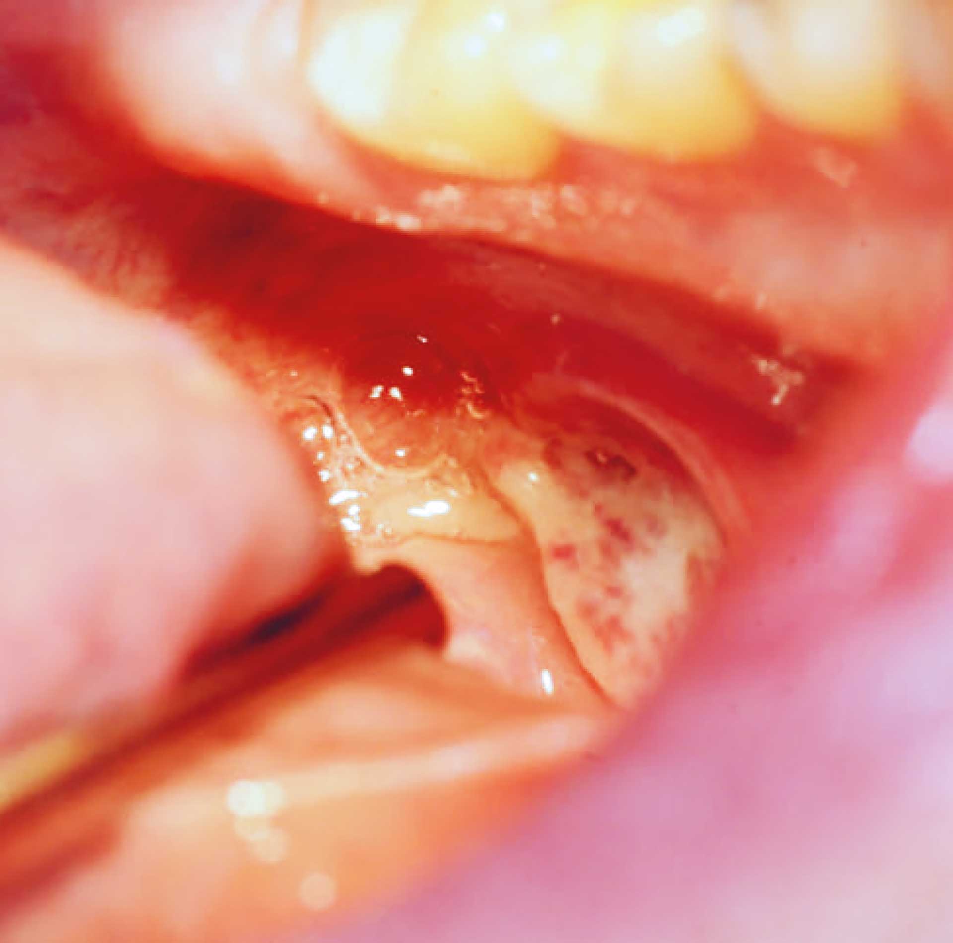 illustrasjon: Mukosal CD30+ lymfoproliferativ sykdom – en sjelden slim­hinnelidelse