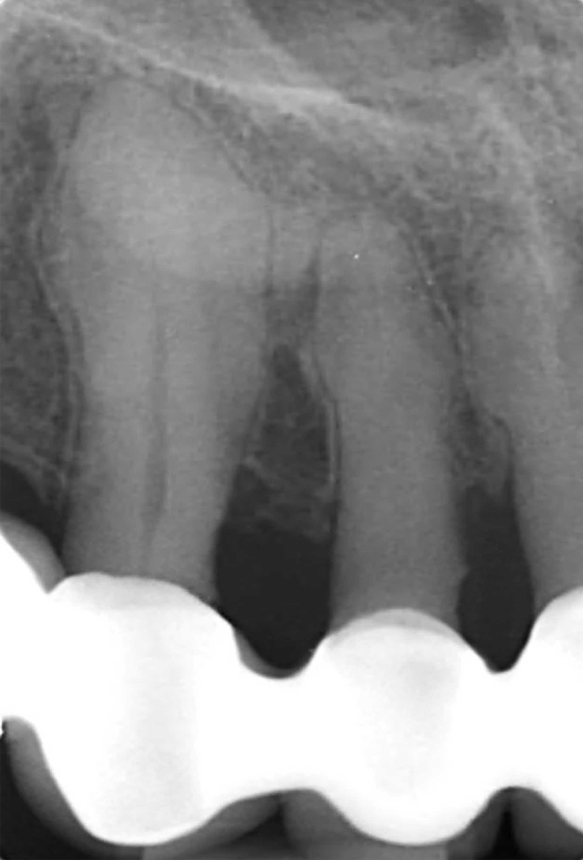 illustrasjon: Hypersementose og endodontiske implikasjoner