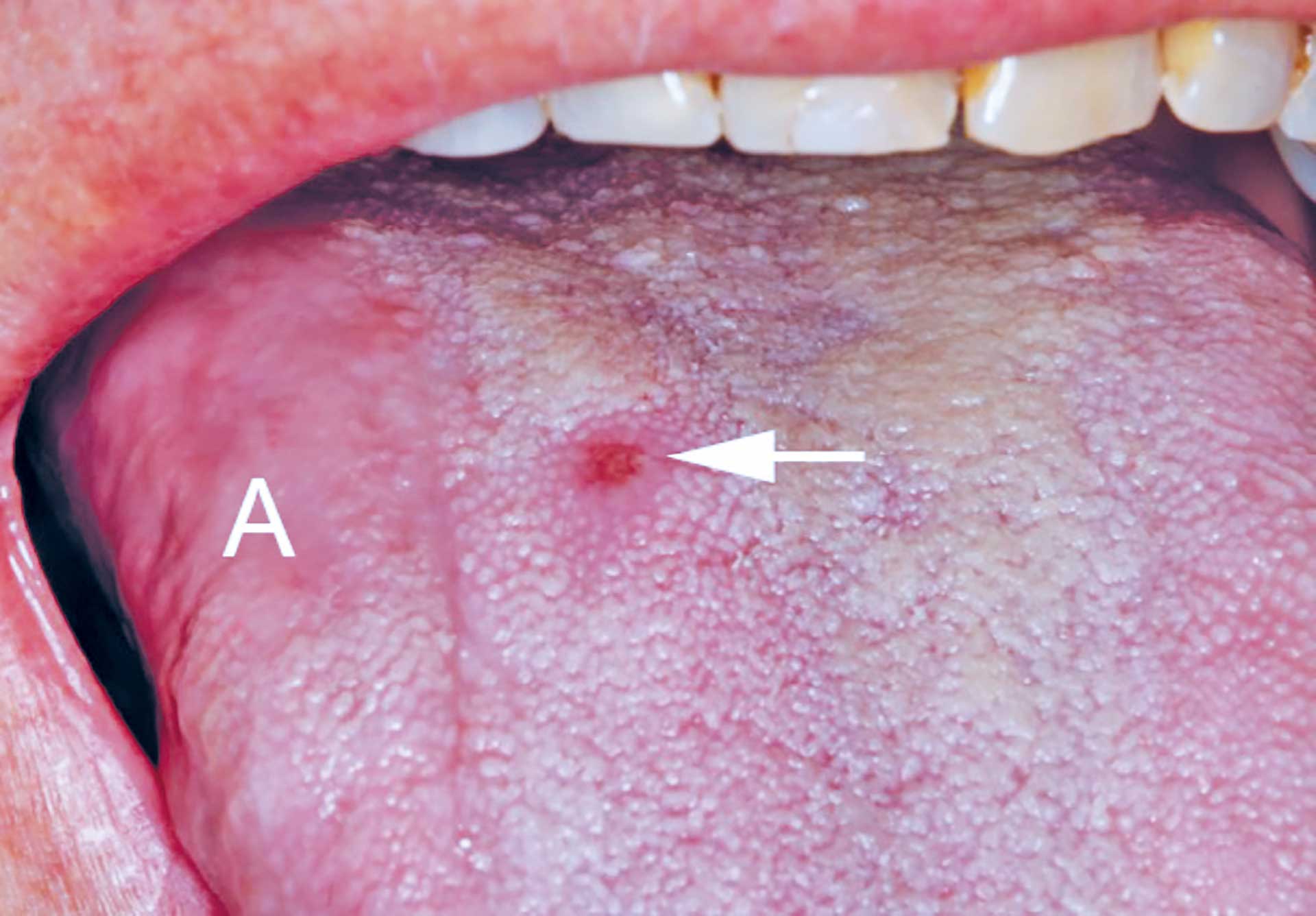 illustrasjon: Oral syfilis er en sykdom som tannleger bør kjenne til