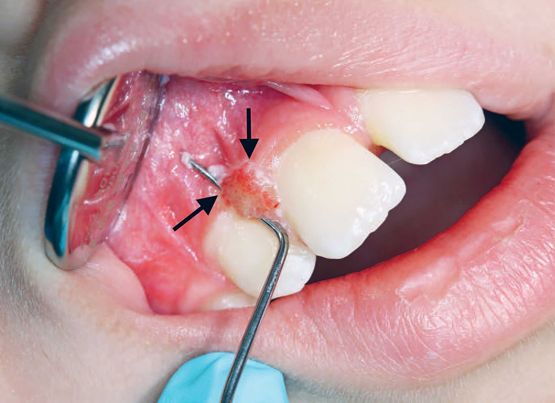 illustrasjon: Lokalisert juvenil spongiotisk gingival hyperplasi: En relativt ny sykdomsenhet