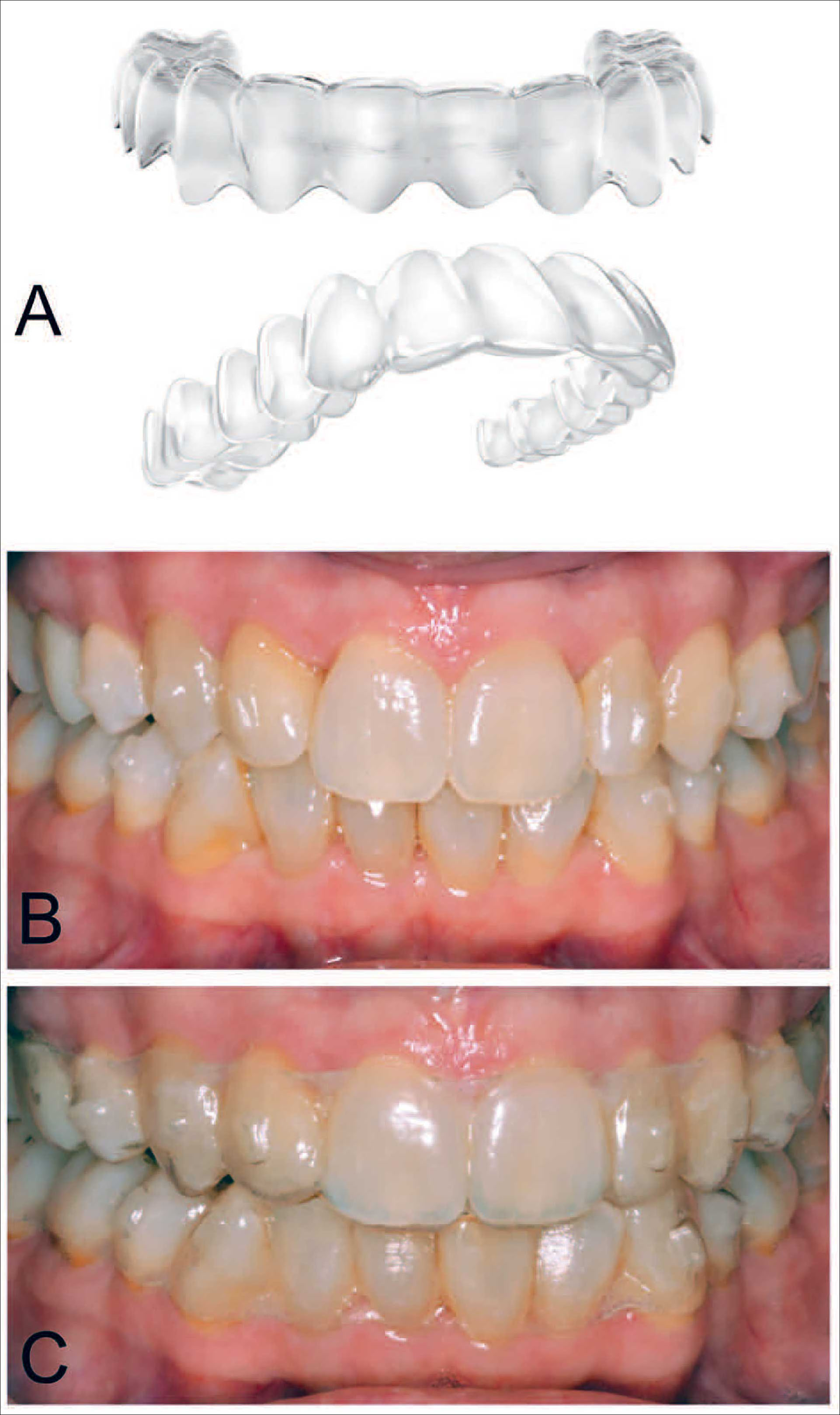 illustrasjon: Tannregulering med alignere