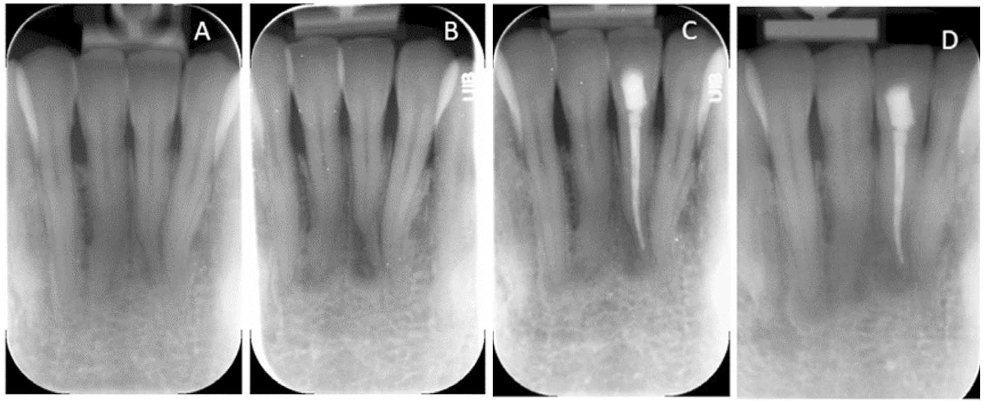 illustrasjon: Cemento-ossøs dysplasi – en diagnostisk utfordring