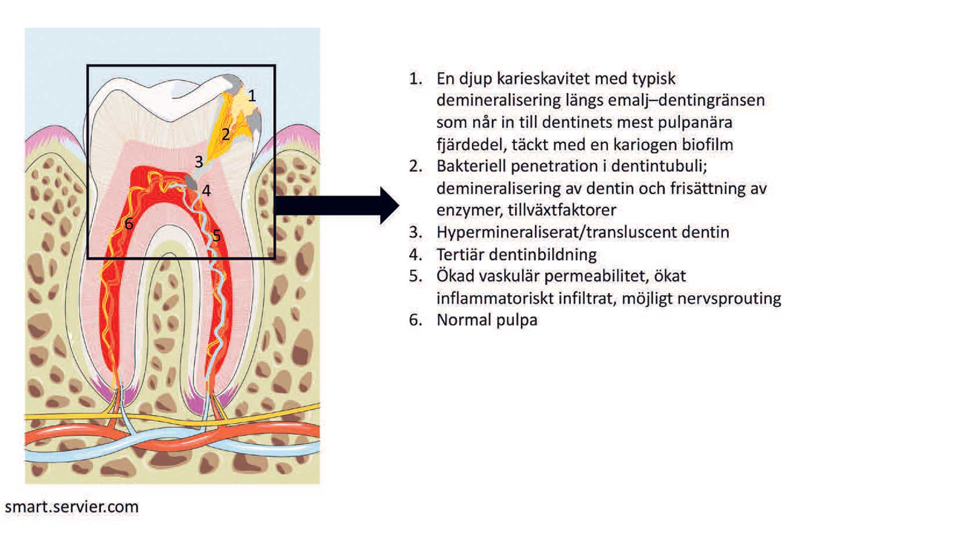 illustrasjon: Behandlingar av vital pulpa i tänder med djupa karieslesioner