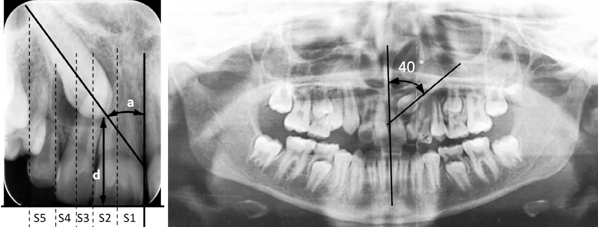 illustrasjon: Oppfølging etter kirurgisk frilegging av retinerte maxillære hjørnetenner i Den offentlige tannhelsetjenesten i Akershus