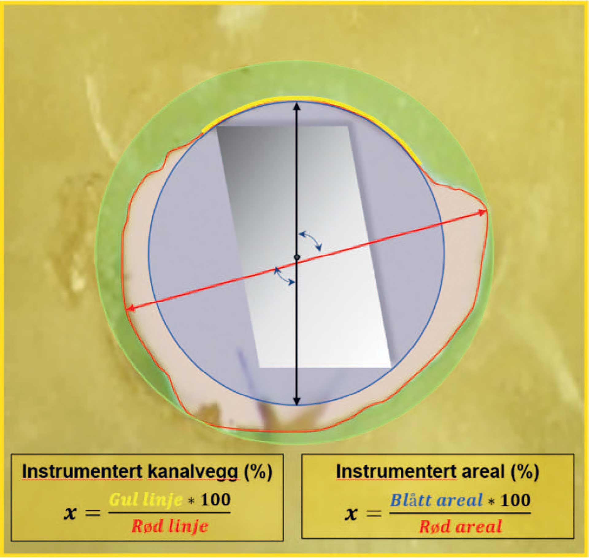 illustrasjon: Mekanisk rens med et resiprokerende endodontisk filsystem. En laboratoriestudie