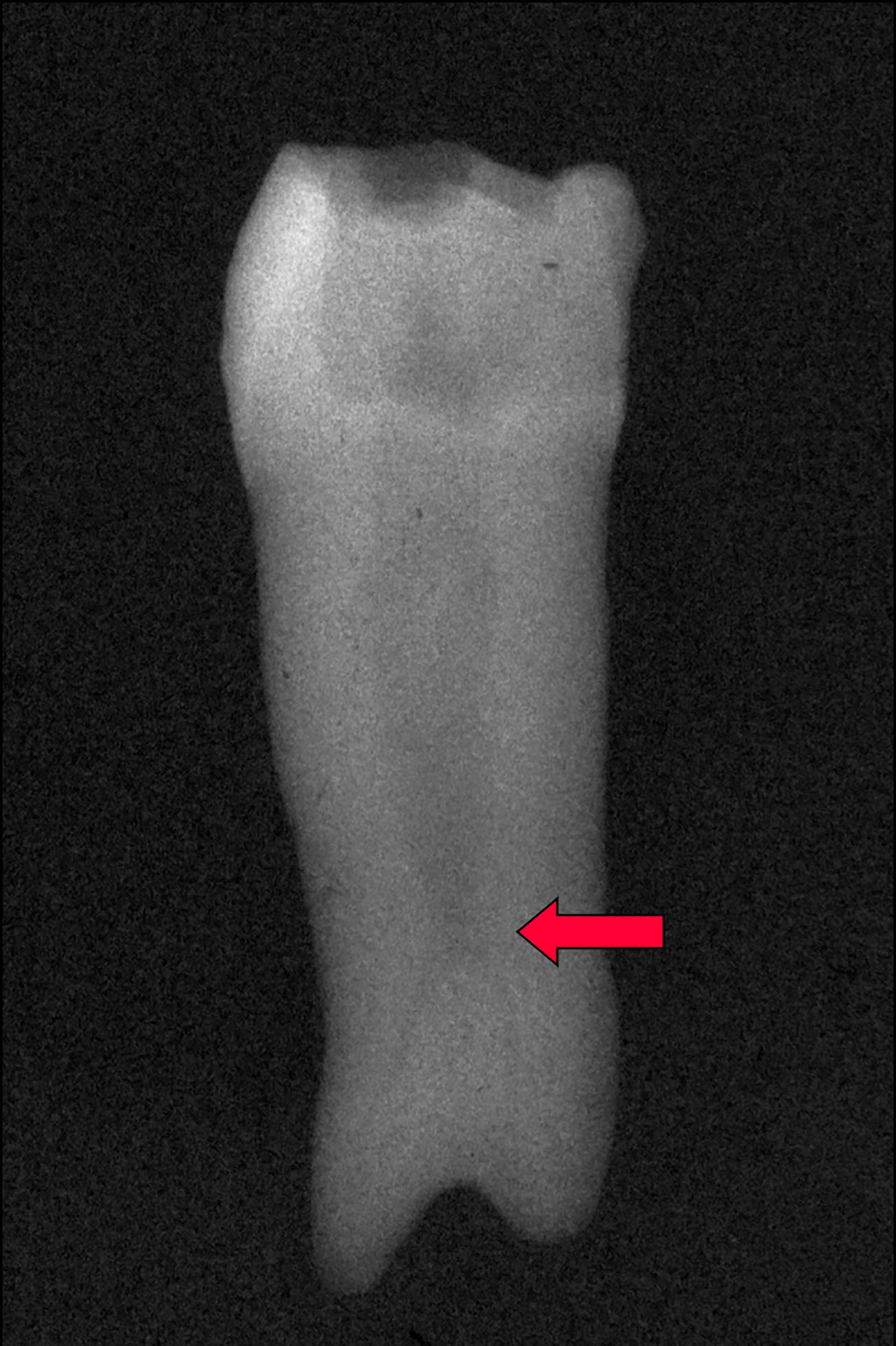 illustrasjon: Taurodontisme og endodontiske vurderinger