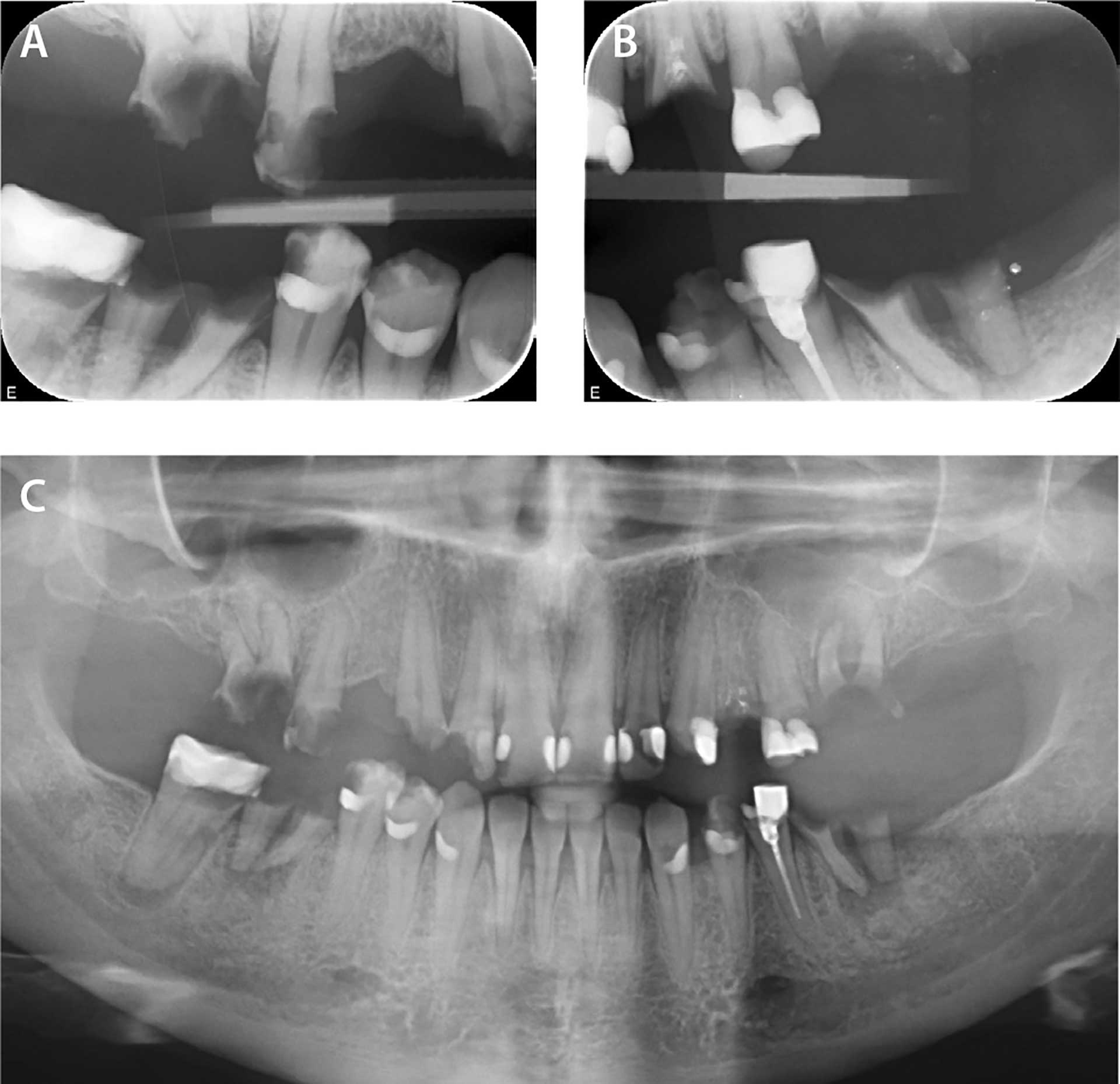 illustrasjon: Tannbehandling etter fedme­operasjon hos pasient med odontofobi – en kasuistikk