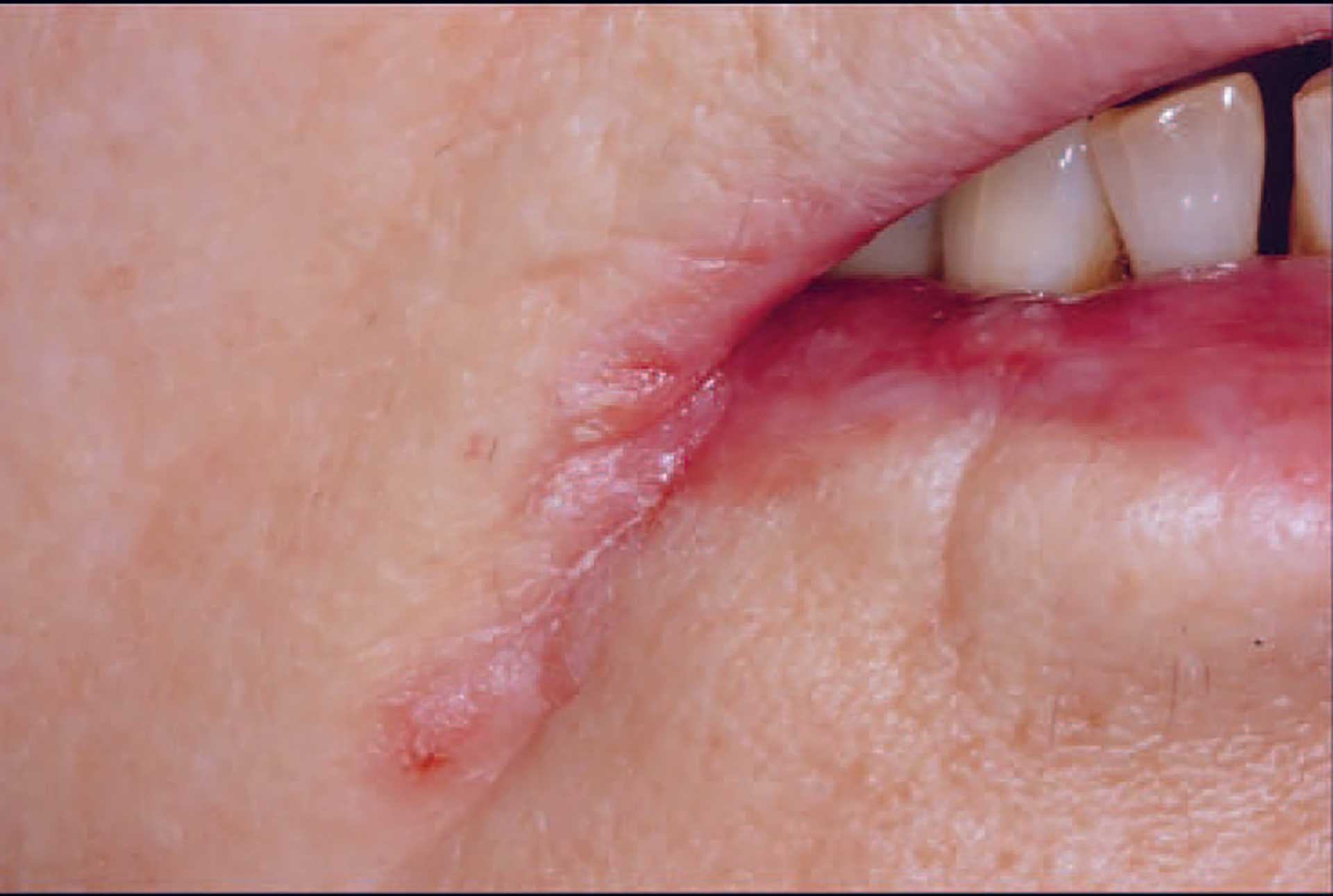 illustrasjon: Common oral mucosal lesions