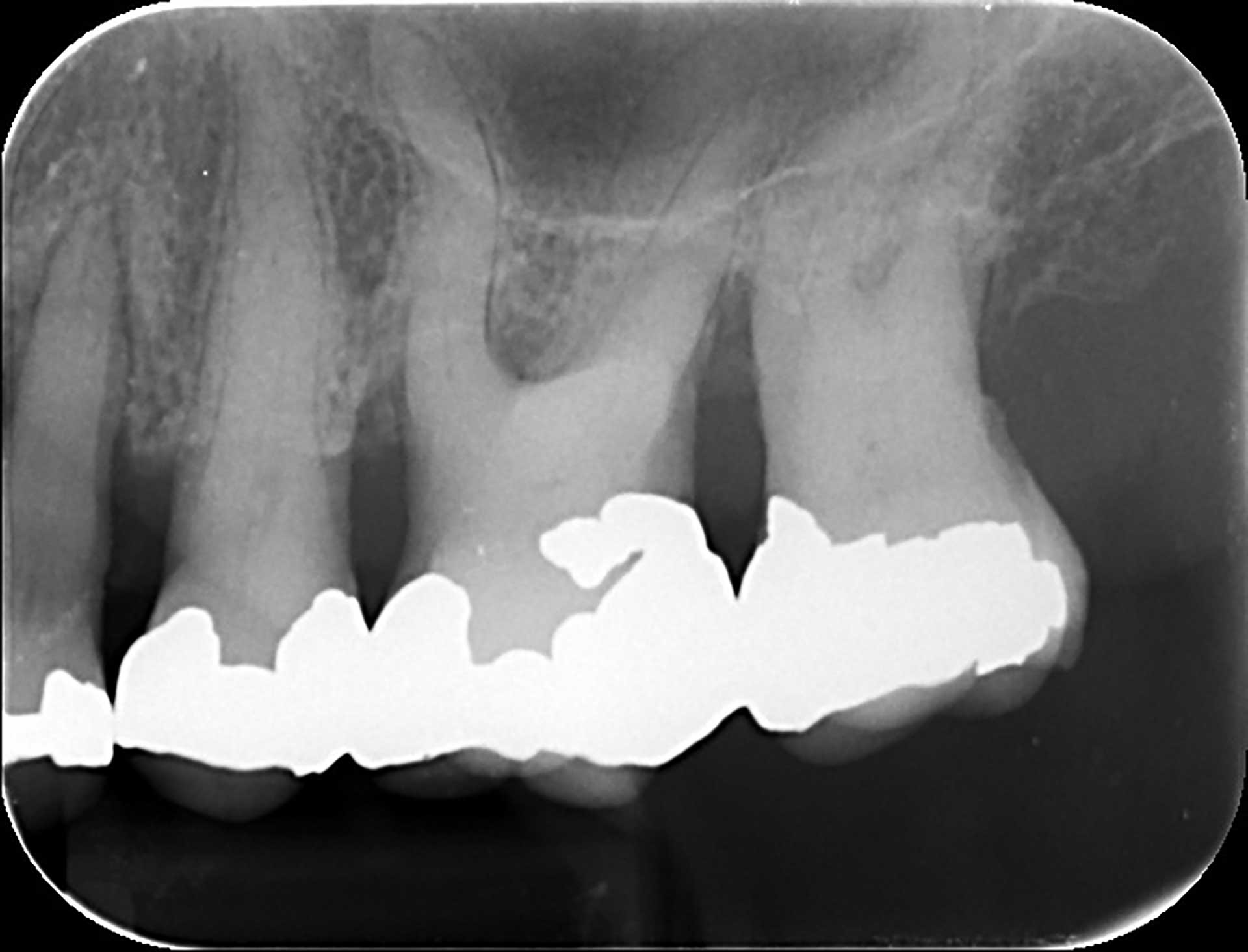 illustrasjon: Lang tids behandling av periodontitt bevarer tennene for de fleste pasienter
